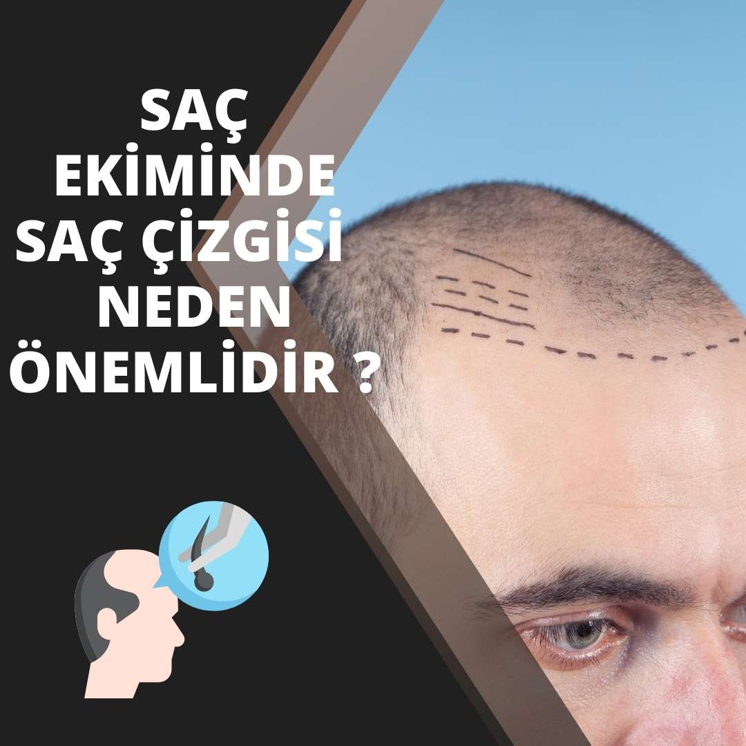 Saç Ekiminde Saç Çizgisi Neden Önemlidir ?