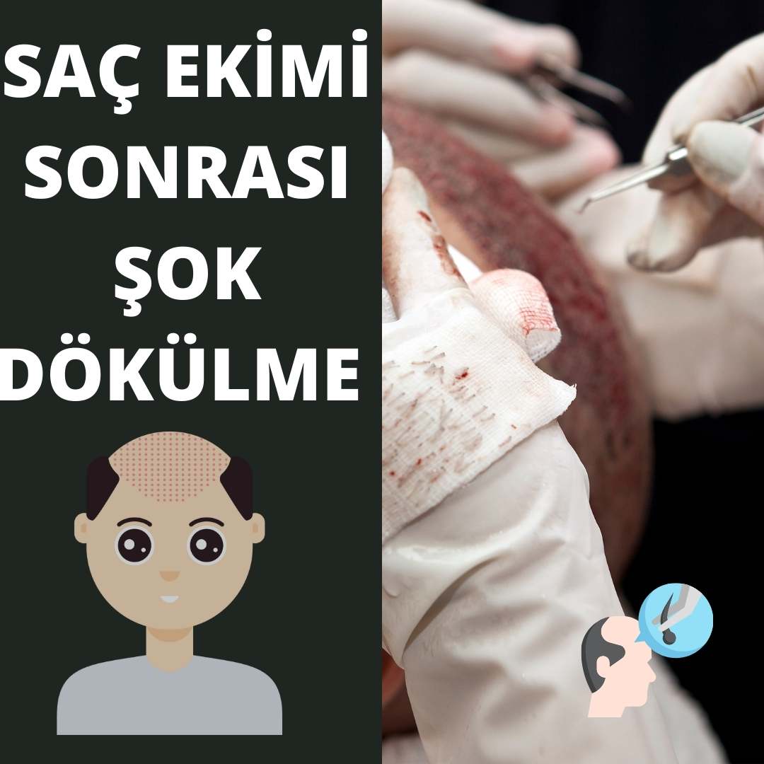 Saç Ekimi Sonrası Şok Dökülme Süreci