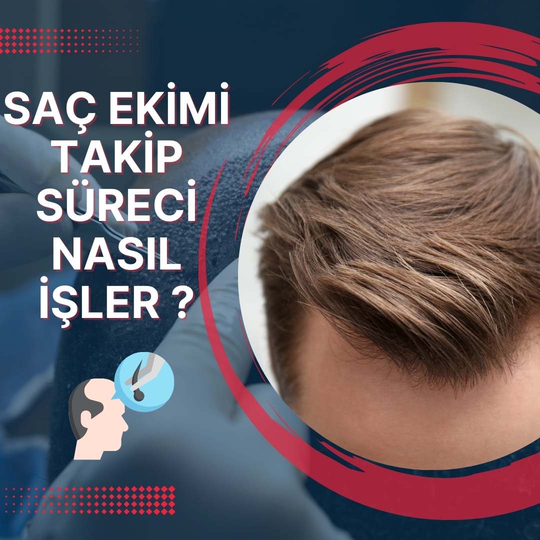 Saç Ekimi Takip Süreci Nasıl İşler?