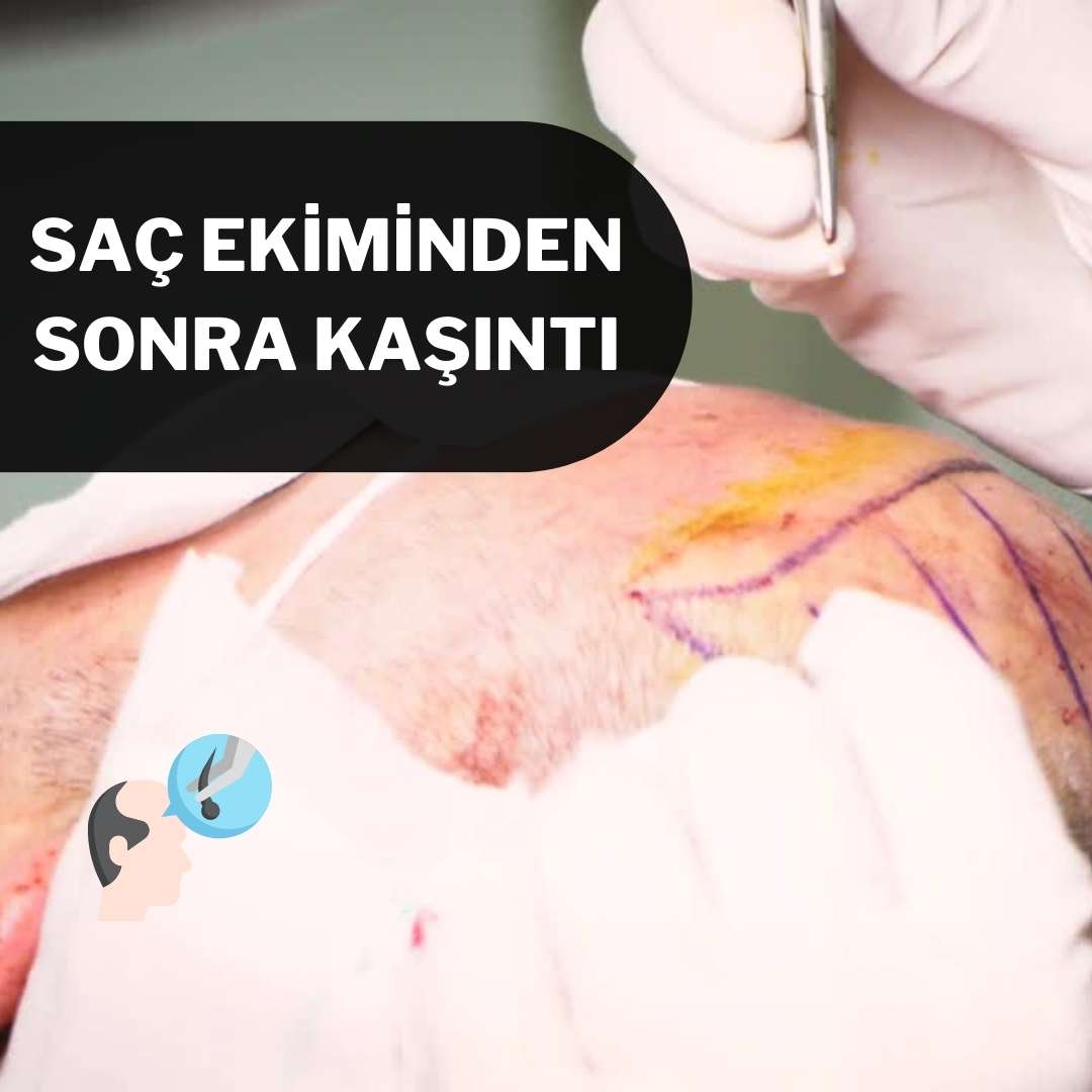 Saç Ekiminden Sonra Kaşıntı