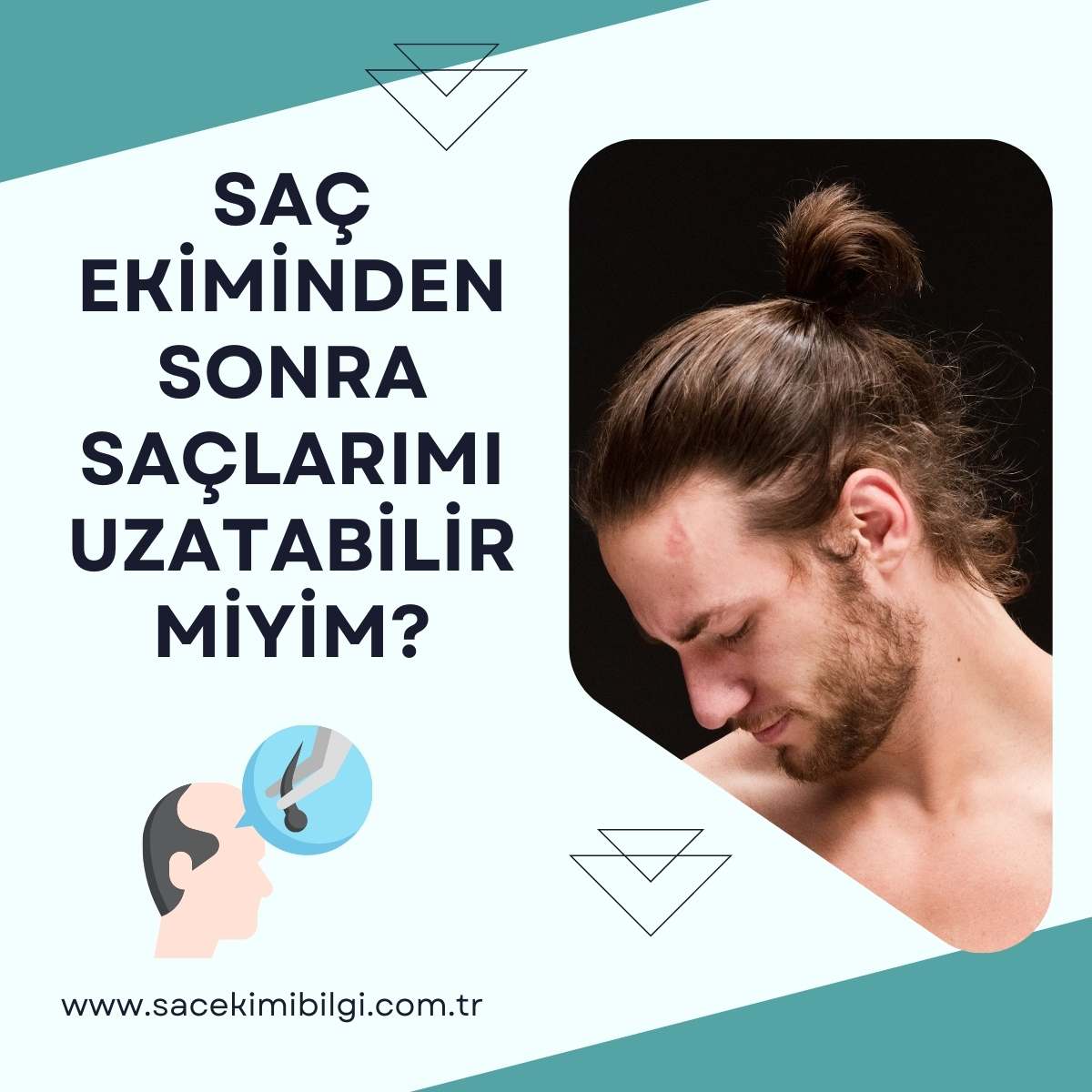 Saç Ekimi Sonrası Saçlarımı Uzatabilir Miyim?