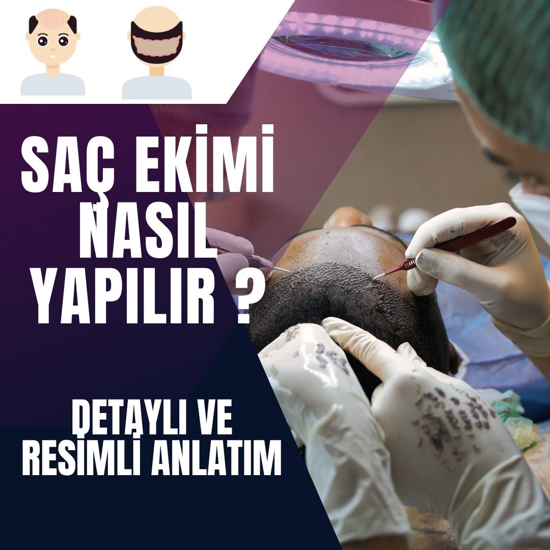 Saç Ekimi Nasıl Yapılır ? Detaylı ve Resimli Anlatım