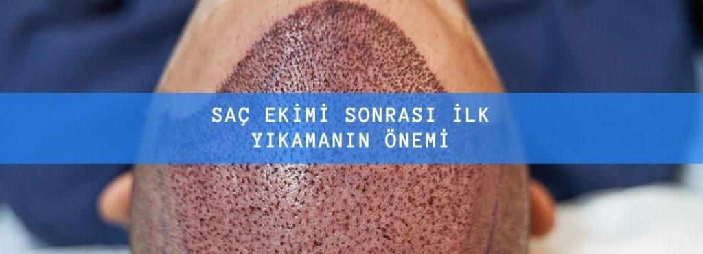 Saç Ekimi Sonrası İlk Yıkamanın Önemi