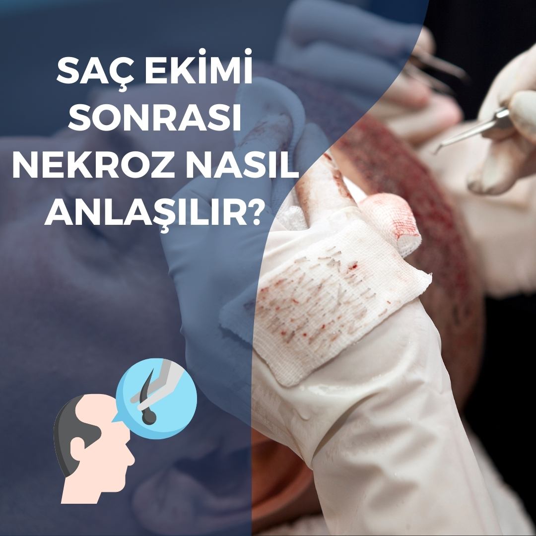 Saç Ekimi Sonrası Nekroz Nasıl Anlaşılır ?