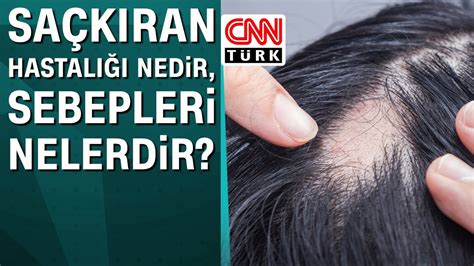 Saçkıran (Alopesi Areata) Nedir ? Tedavisi Nasıl Yapılır?